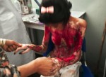 Thumbnail image: Stephanie Sinclair<br>Marzia Bazmohamed, 15, screams in pain while having her burns cleaned. This painful ritual was performed daily by the nurses until a new technique was shown to them by a French NGO, 2003-2005