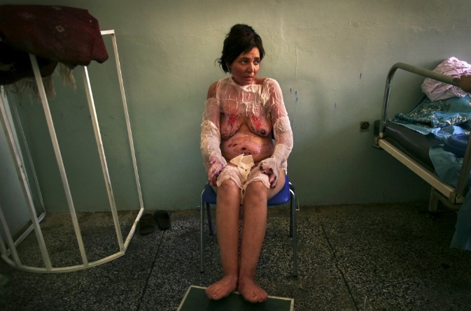 Stephanie Sinclair<br>Fauza Yusufzai sits naked while waiting for new dressings to be put on her burns. Faiqa denies burning herself on purpose, which is often the case for fear of being an embarrassment or being treated poorly by hospital staff, but relatives confirm that she self-immolated, 2003-2005