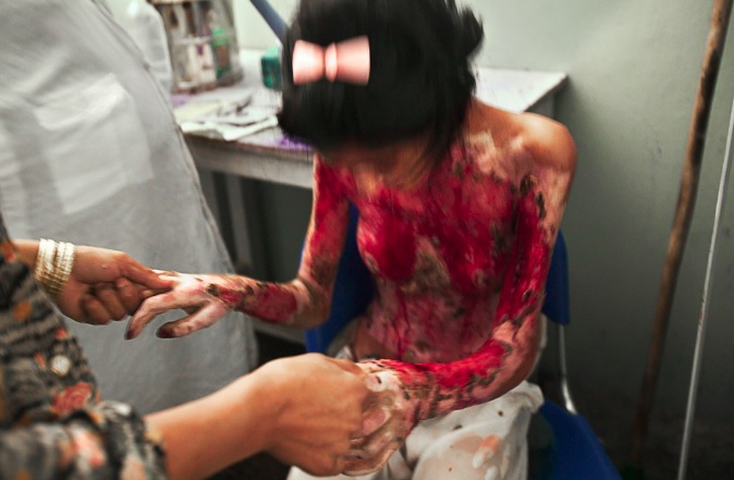 Stephanie Sinclair<br>Marzia Bazmohamed, 15, screams in pain while having her burns cleaned. This painful ritual was performed daily by the nurses until a new technique was shown to them by a French NGO, 2003-2005